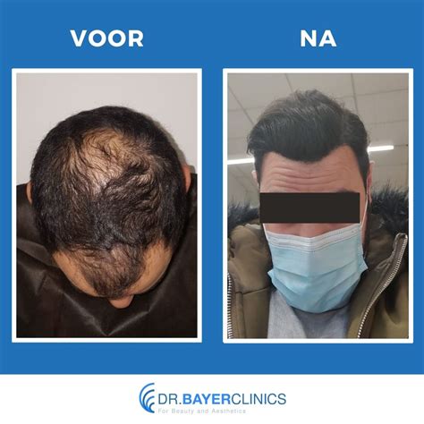 De Pre-Operatieve Fase Voor Haartransplantatie