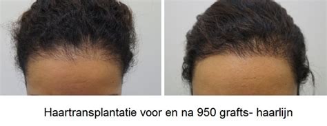 Haartransplantatie Voor Vrouwen: Wat Zijn De Verschillen?