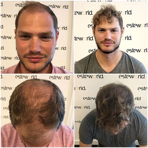 Nieuwe Trends In Haartransplantatie