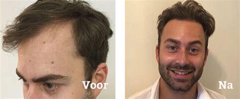 Bewezen Resultaten Van Haartransplantatie