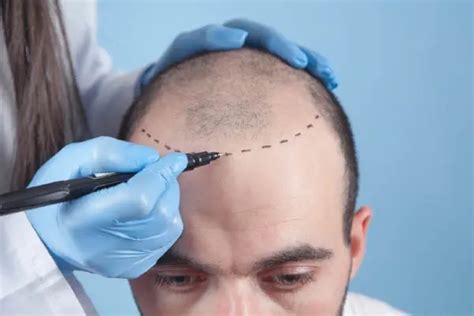 Wat Is De Hersteltijd Na Een Haartransplantatie?