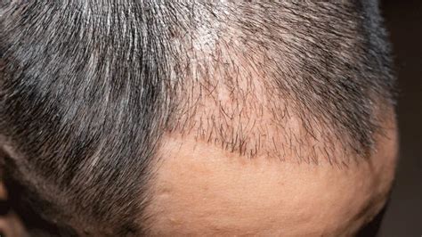 De Bijwerkingen Van Een Haartransplantatie