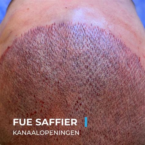 Haartransplantatie Saffier FUE: Voordelen En Nadelen