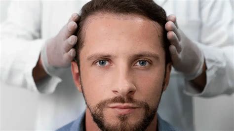 Haartransplantatie En Medicijnen: Welke Beperkingen Zijn Er?
