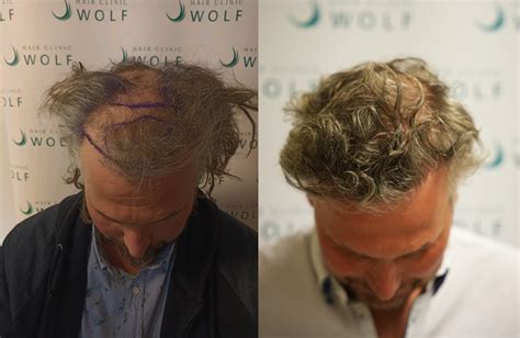 Haartransplantatie En Rimpels: Wat Je Moet Weten