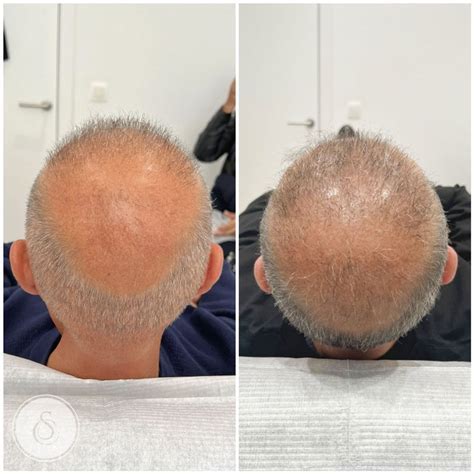 Haartransplantatie Voor En Na: Effectieve Resultaten