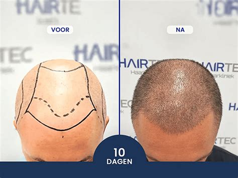 Haartransplantatie: Wat Zijn De Beste Technieken?