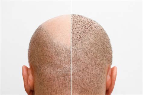 Optimale Nazorg Na Een Haartransplantatie