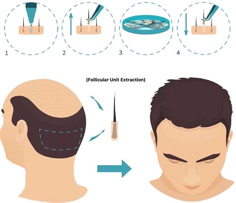 Stap Voor Stap: Het Haartransplantatie Proces