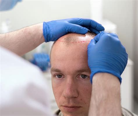 Wat Te Doen Als Haartransplantatie Niet Werkt?